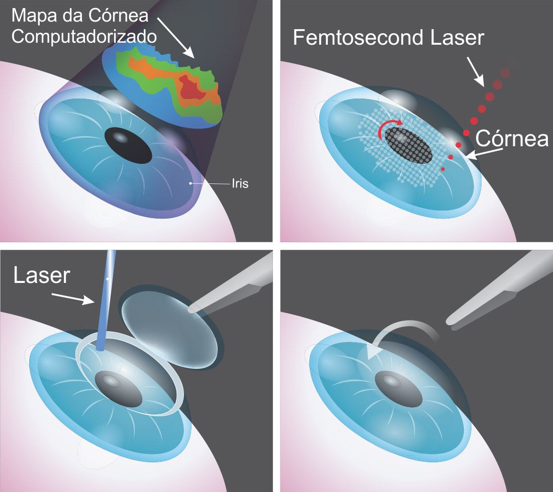 Conheça as Técnicas para Cirurgia a Laser: LASIK, PRK, ILASIK