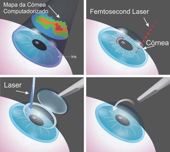 Imagem Técnicas para Cirurgia a Laser: LASIK, PRK, ILASIK